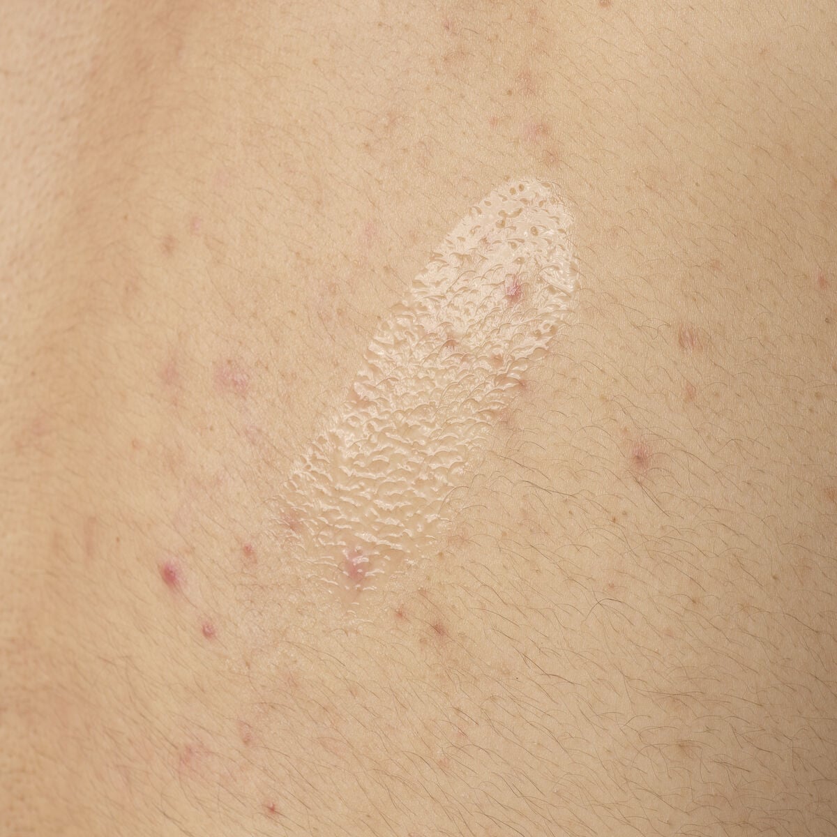 salicylic-acid-0-5-body-serum-q6 ORD-salicylic-acid-05-body-240ml-application.jpg