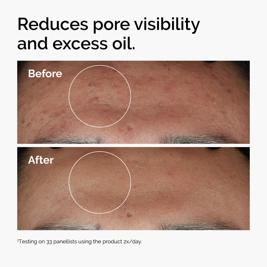 niacinamide-10-zinc-1-r6 ord-niacinamide-zinc-blemish-serum-before-after-pores.jpg