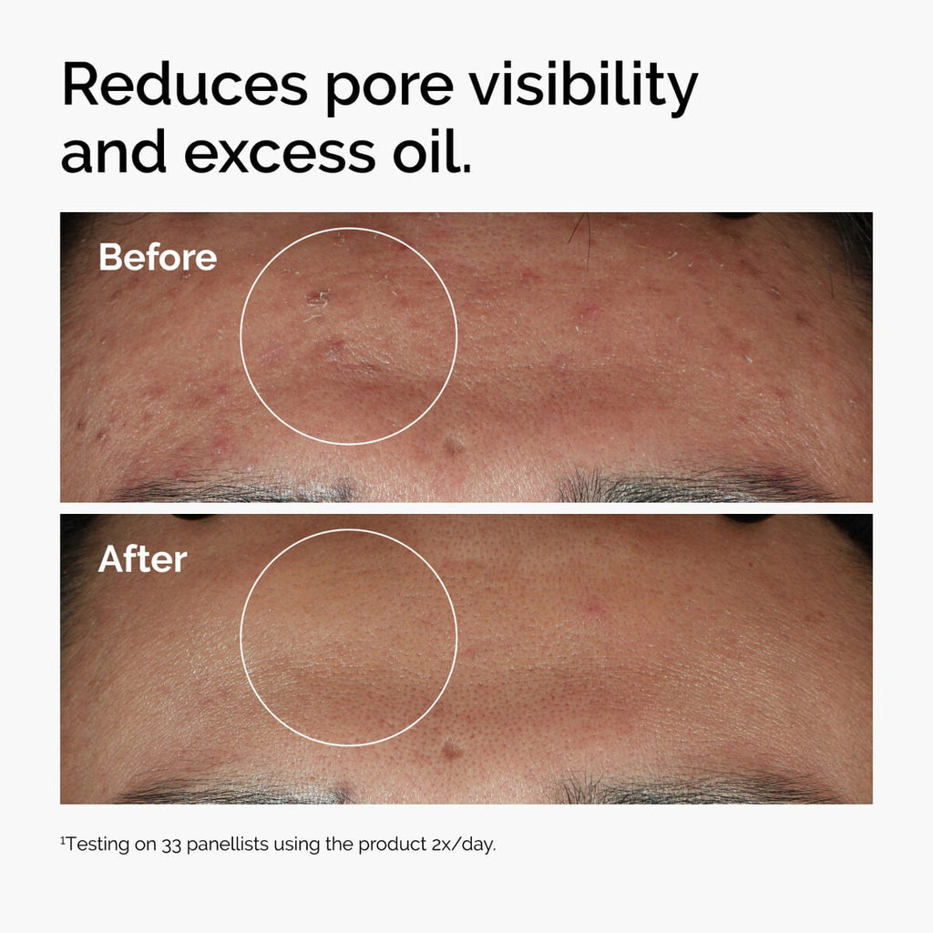 niacinamide-10-zinc-1-r6 ord-niacinamide-zinc-blemish-serum-before-after-pores.jpg