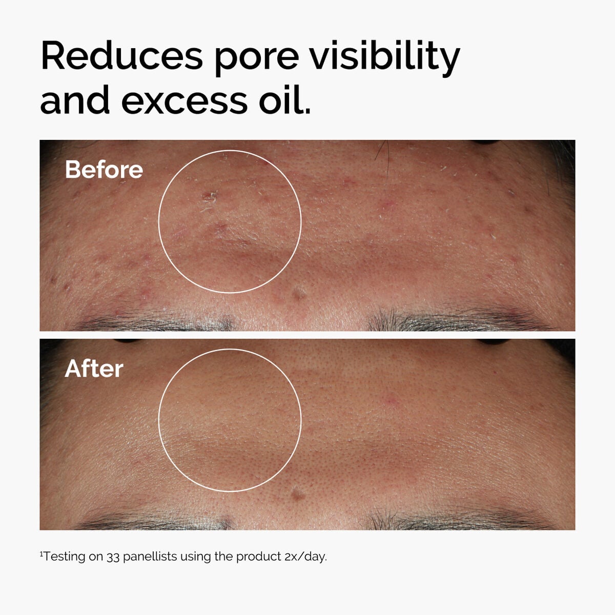 niacinamide-10-zinc-1-r6 ord-niacinamide-zinc-blemish-serum-before-after-pores.jpg