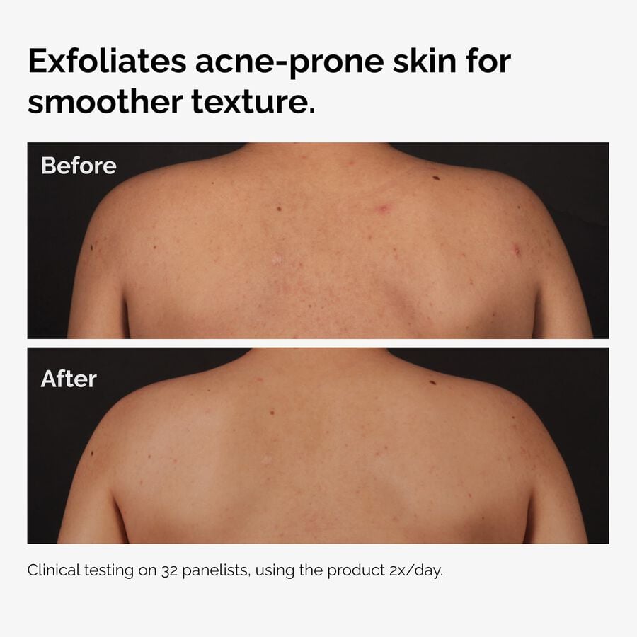 the-body-care-collection-h6 ord-salicylic-acid-body-serum-before-after-graphic-NA.jpg