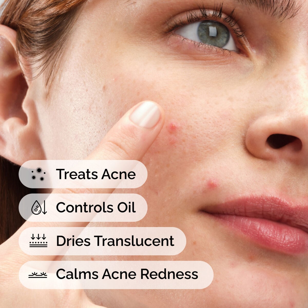 sulfur-10-powder-to-cream-concentrate-j9 ord-sulfur-10pct-powder-to-cream-concentrate-model-application-with-benefits-acne.jpg