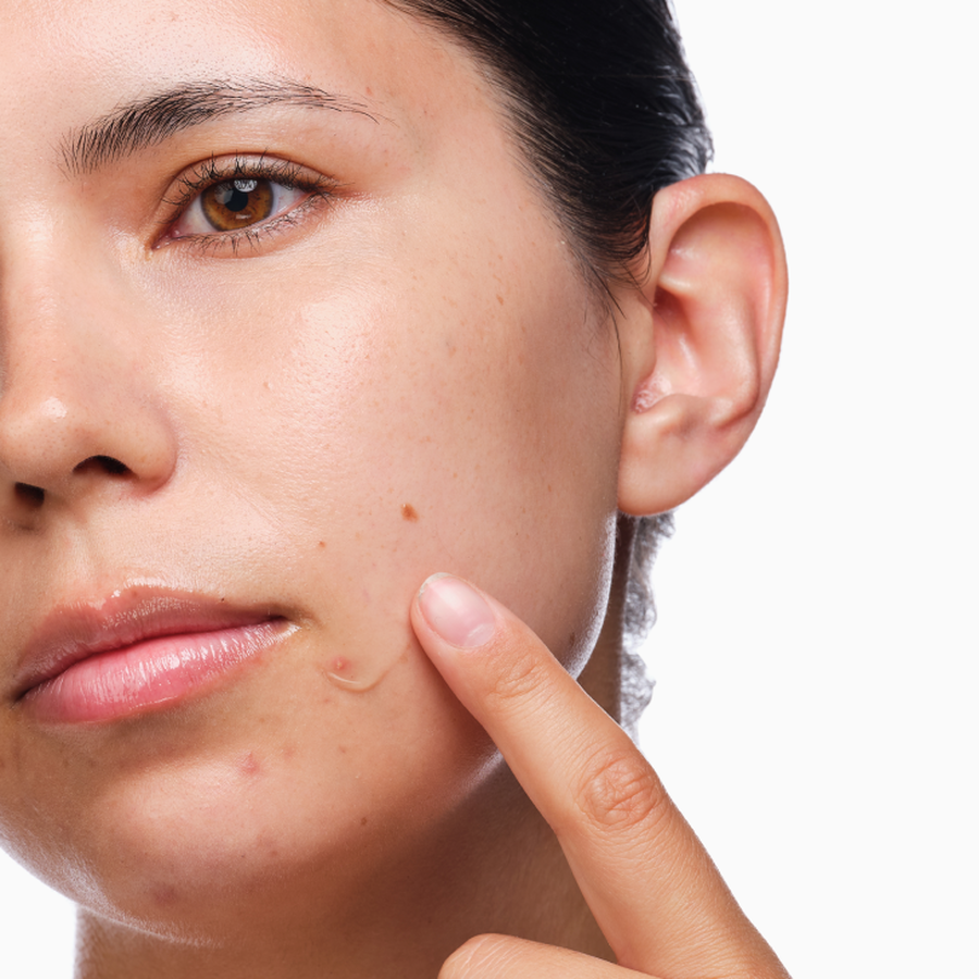 the-acne-set-f6 rdn-the-acne-set-application.png